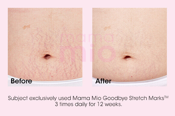 mama mio goodbye stretch marks cream