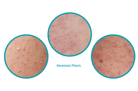 Keratosis Pilaris Explained What It Is And How To Treat It